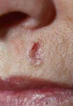 Basal Cell Carcinoma