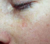 Basal Cell Carcinoma