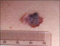 MELANOMA